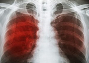 Senior Care in Hamilton NJ: What is Tuberculosis?